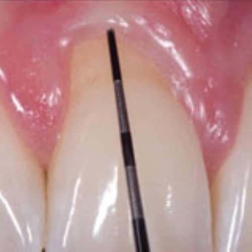 Implant uncoverage in esthetic areas - basic considerations